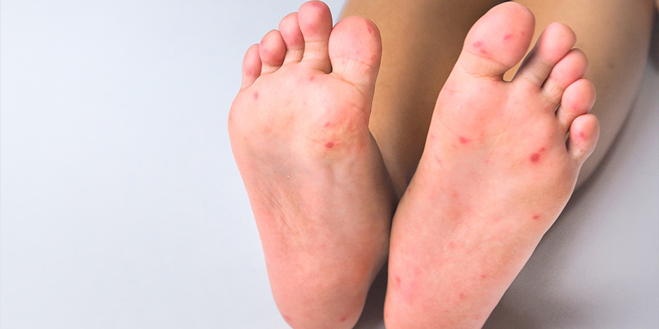 Boutons rouges sur les pieds d’un enfant, causés par la maladie pieds-mains-bouche