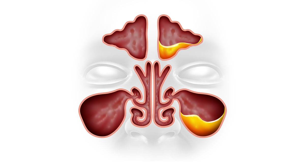 Illustration of the sinuses.